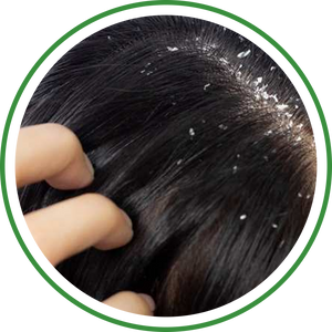 Dandruff