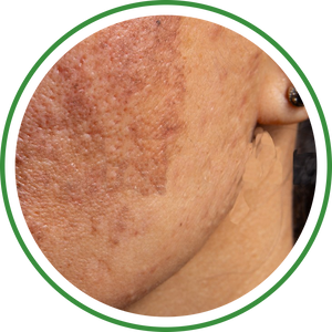 Pigmentation